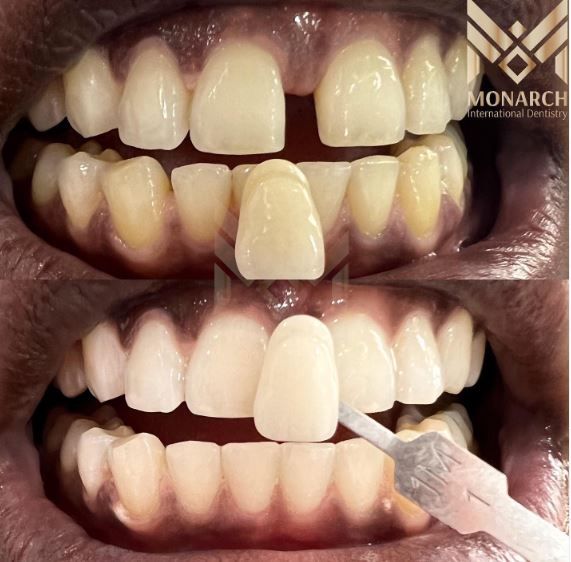 After only one teeth whitening session, patient's got 3 shades whiter! From 3R1.5 to 1M1! in Turkey, Antalya